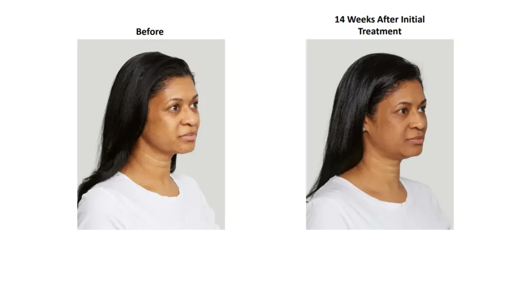 Before and after Sculptra treatment showing enhanced facial volume.