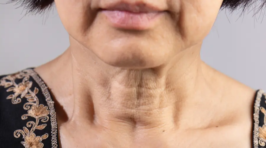 Sculptra Address Aging in the Neck and Chest